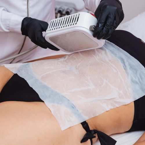 Application of cryolipolysis, cryotherapy, preparing to apply to the patient's abdomen, with a single plate of the cryolipolysis device. patient smiling
